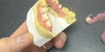 Partial Denture & Full Dentures